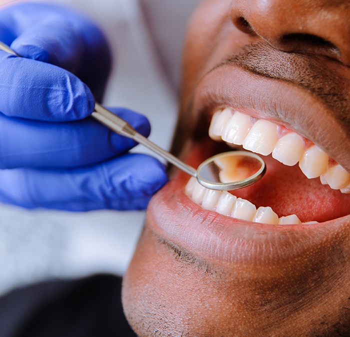 Dentist examining patient's smile after tooth colored filling placement