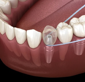 Flossing dental implant in Houston