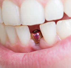 Close-up of a single dental implant in Houston, TX in patient’s jaw