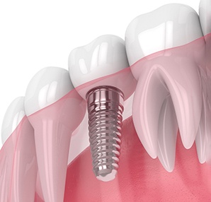 Illustration of dental implant in Houston, TX after receiving dental crown