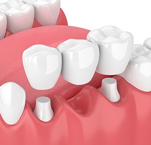 illustration traditional dental bridge in Houston 