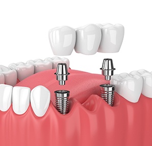 illustration implant dental bridge in Houston 