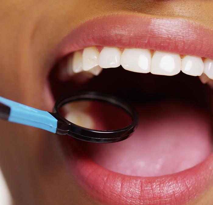 Closeup of smile after metal free dental restoration