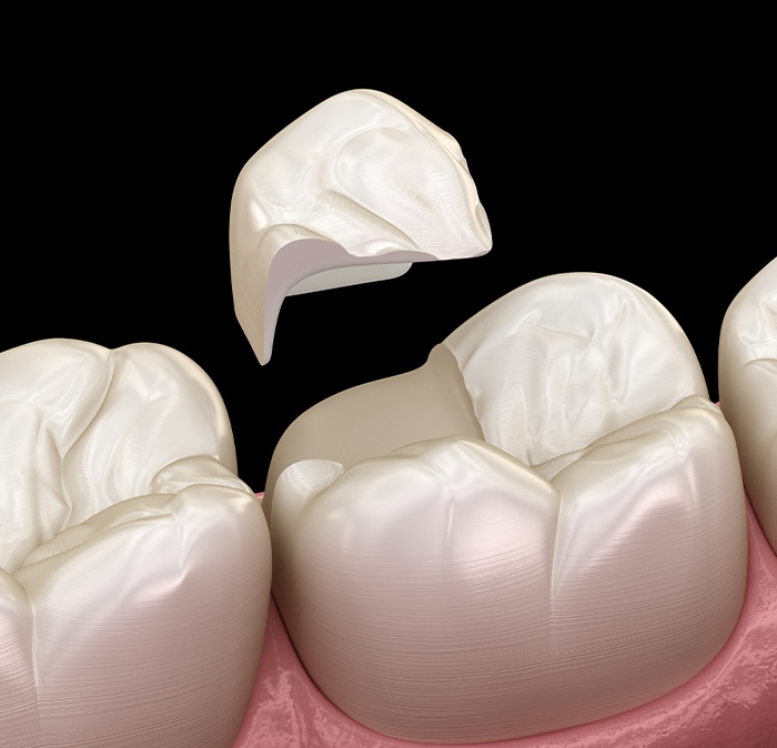 Animated smile during tooth colored filling placement