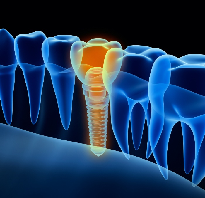3 D animated rendering of smile with dental implant supported replacement tooth
