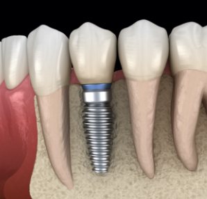 Animated smile with a dental implant supported dental crown