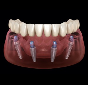 Animated dental implant supported denture placement