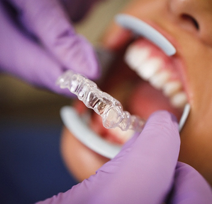 Dentist in Houston placing Invisalign trays in patients mouth