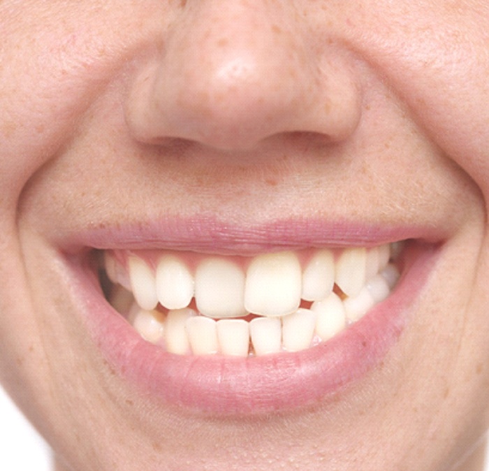 Closeup of patient with crooked teeth smiling