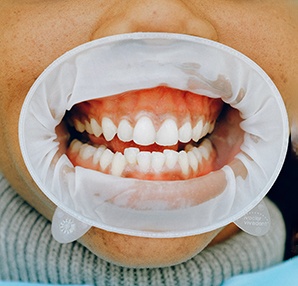 Woman’s mouth with misaligned teeth