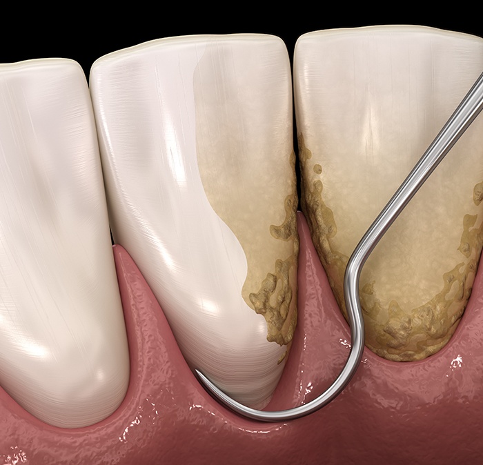 Animated smile during scaling and root planing periodontal therapy