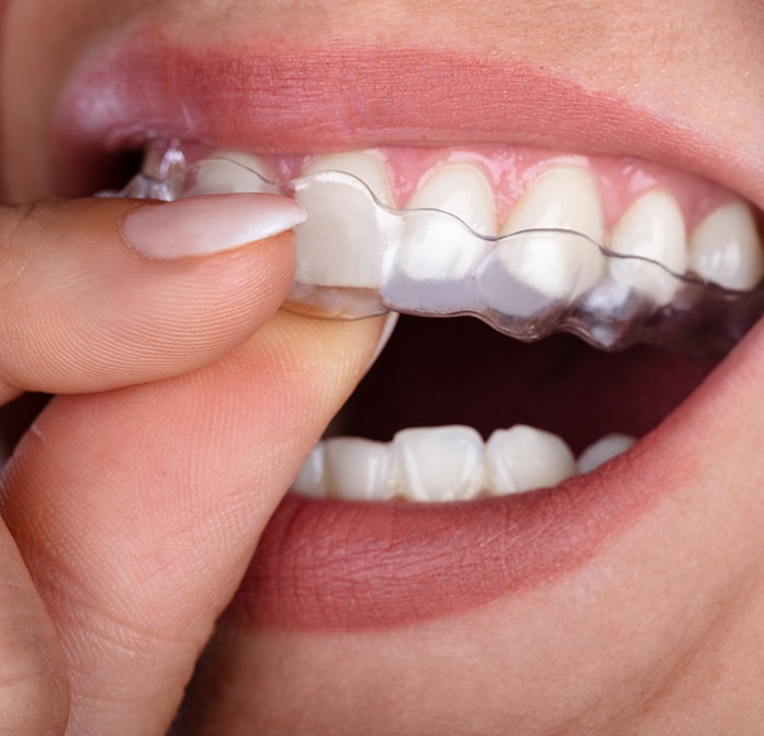 Closeup of patient placing a nightguard for bruxism