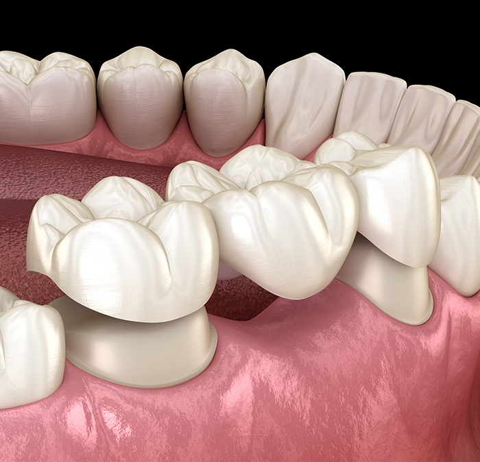 Animated dental crown supported fixed bridge placement