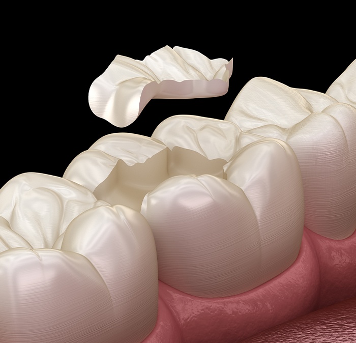 Animated smile during tooth colored filling placement