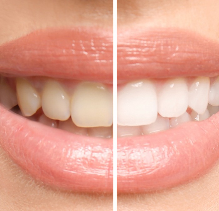 Closeup of a smile with a line down the middle to show before/after whitening results
