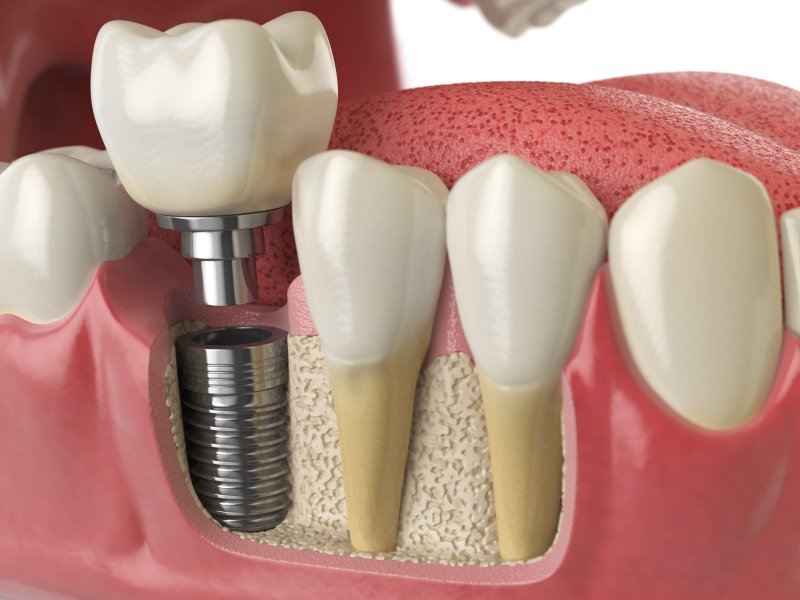A 3D illustration of a dental implant next to natural teeth