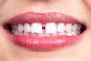 Gap between two front teeth.